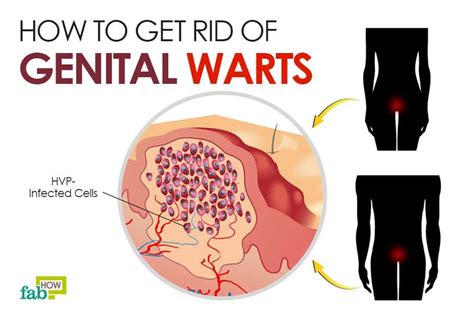 Can I Ever Have Unprotected Sex Again With Genital Warts
