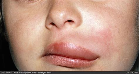 stock image 01aq1w05 allergy angioedema of the lip gross swelling