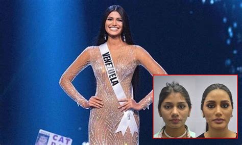 Cosmetic Surgery Photos Of Miss Venezuela Go Viral After