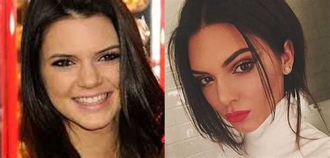 how real are the kardashians kendall jenner plastic surgery exegesis