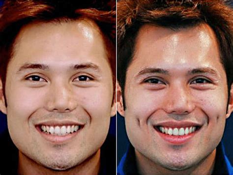 New Cosmetic Surgery Dimpleplasty Gives You Dimples Like Mario Lopez