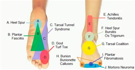 foot pain diagram    foot hurt