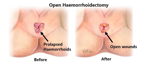 haemorrhoids colorectal surgeons sydney