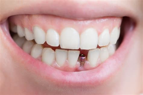 dental implants jiva dental