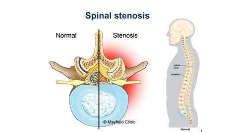 lumbar spinal stenosis stepwards