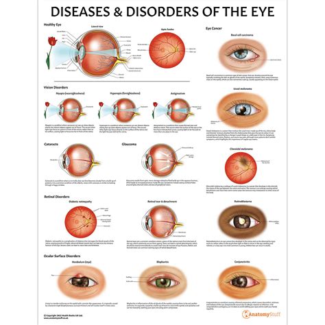 diseases  disorders   eye chartposter laminated