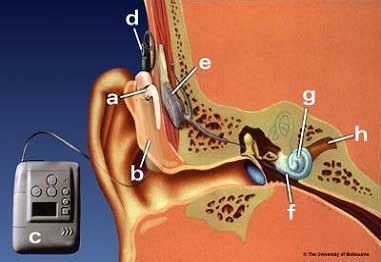 cochlear implant work parts  cochlear implants