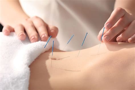 ottawa acupuncture ottawa pro care physiotherapy