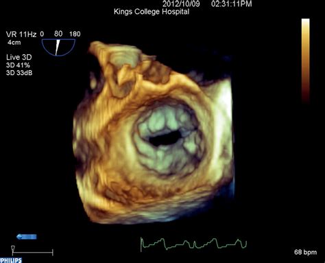 Accurate Assessment Of The True Mitral Valve Area In