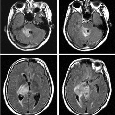 Axial Flair Mri Images Showing Typical Neuro Behçets Disease Lesions