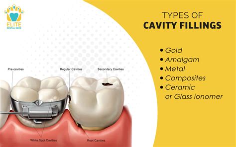 types  cavity fillings elite dental care tracy elite dental care