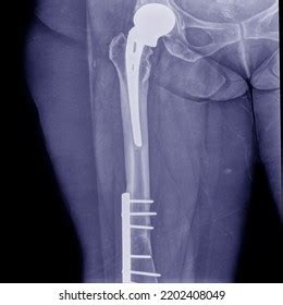 hip thigh xrays hip thigh splints stock photo  shutterstock