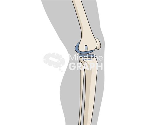 medial unicondylar knee arthroplasty mobile bearing lateral body mind