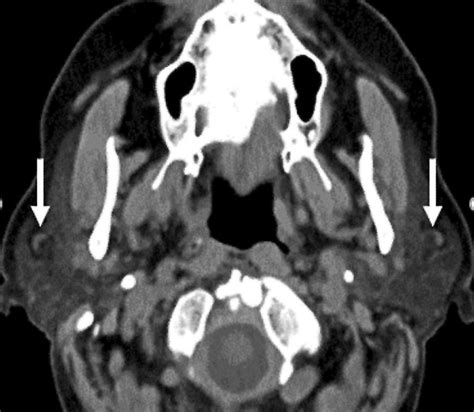Axial Ct Demonstrates Normal Parotid Lymph Nodes Often Seen Within This