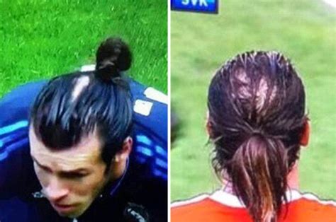 gareth bale to get hair transplant after being