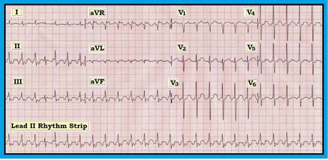 ecg interpretation march 2012