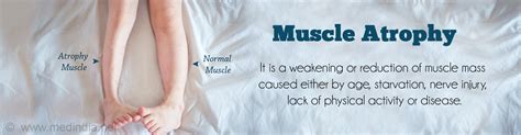 muscle atrophy  symptoms diagnosis treatment prevention