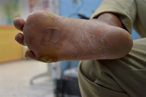 diabetes dry hands  feet diabeteswalls
