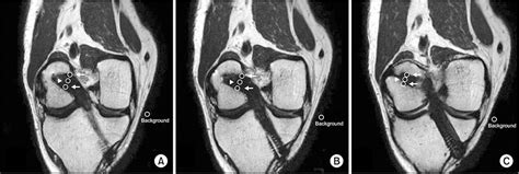 magnetic resonance imaging and clinical results of outside in anterior