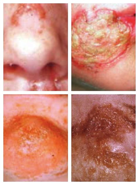 Skin Infections Pictures Video Causes And Treatment