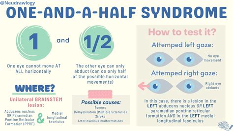 syndrome   eye  move  grepmed