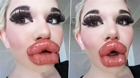 woman shows   post procedure lips   lip injection