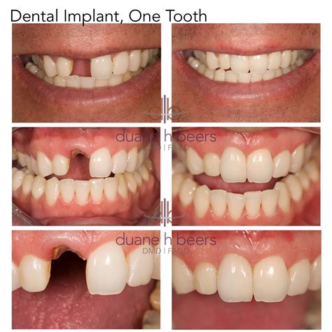 dental implant single tooth
