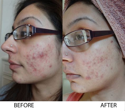 turmeric  acne pimples treatment  scars removal beautyhealthplus