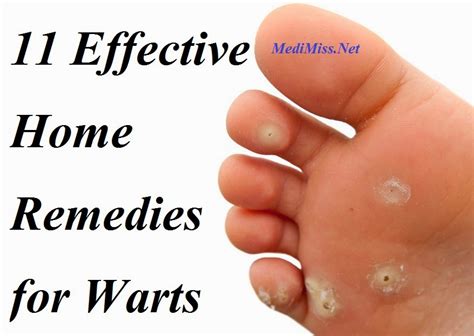 effective home remedies  warts skinnyzine