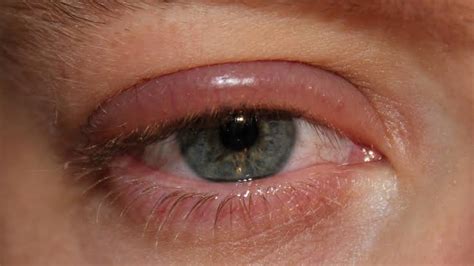 subtle signs  eye infections circulating