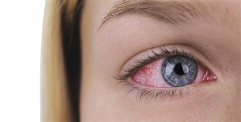 como prevenir y tratar las alergias de los ojos vivemichigan
