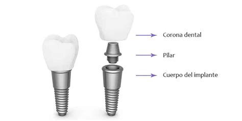 Partes De Un Implante Dental Ferrusandbratos