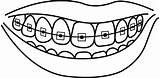 Braces Smile Cavity Dentistry Webstockreview Pngitem sketch template