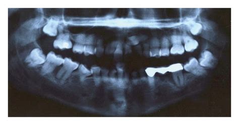 Dental X Rays Performed At The Age Of 6 A And The Age Of 19 B The