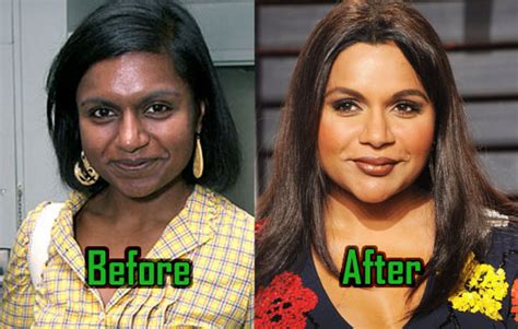 mindy kaling plastic surgery enhances  nose  lips