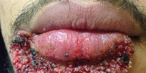 Man Develops Rare Fungal Infection After Popping Zit With