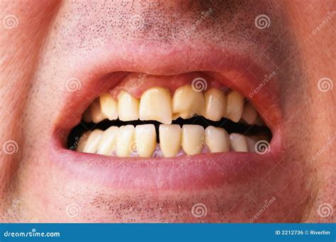broken teeth stock photo image  healthcare destroyed