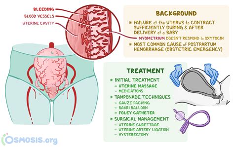 uterine atony what is it risk factors treatment and more osmosis