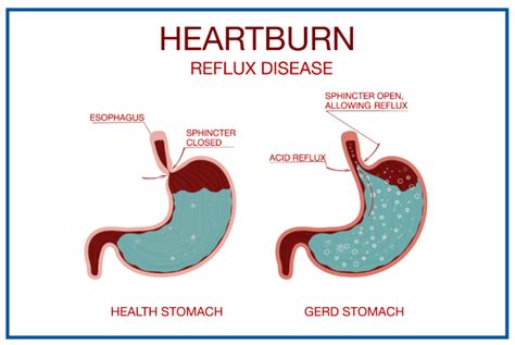 heartburn  symptoms prevention treatment medicover