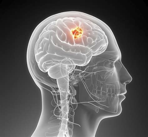 brain tumors brain cancer neurosurgery  endovascular associates