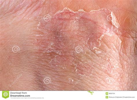 eczema  skin stock images image