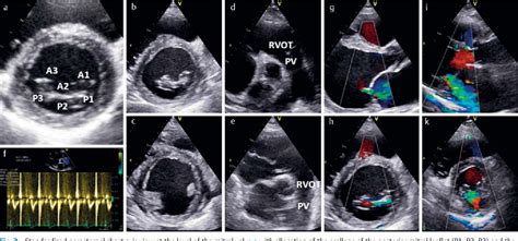 Figure 6 From Standardized Transthoracic Echocardiography In Patients