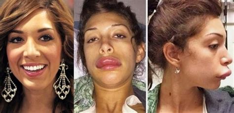 plastic surgery gone wrong for these 15 actresses