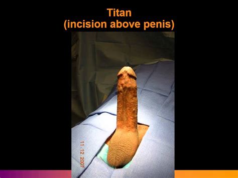 erectile dysfunction surgical treatment and penile implants youtube