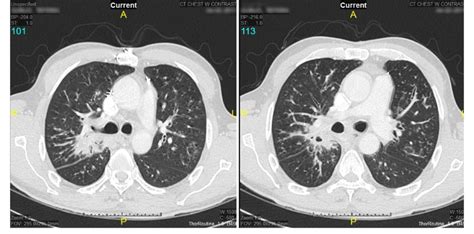Computed Tomography Ct Scan Of The Chest With A Right Hilar Region