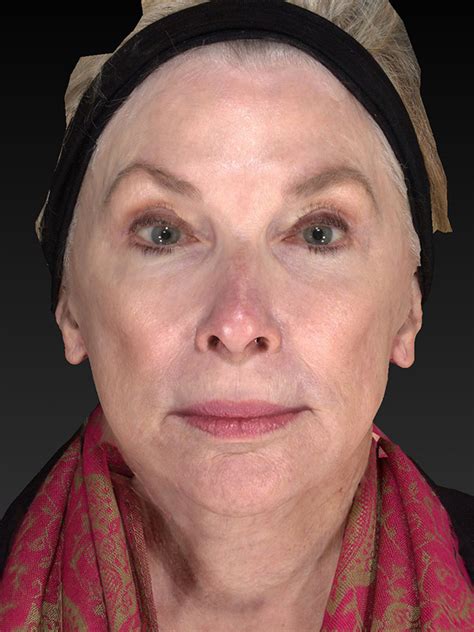 Facelift Lower Face And Neck Lift Before And After 14