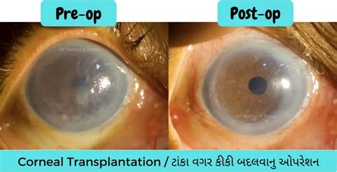 cornea transplant surgery eye transplant surgery  ahmedabad