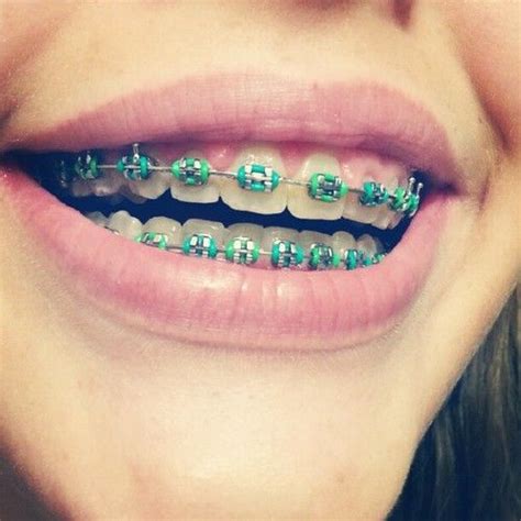 Pick Your Best One With The Help Of Braces Color Wheel Braces Colors