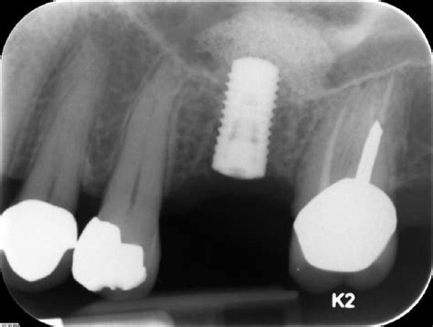 Dental Implant Surgery A Permanent Tooth Replacement Procedure The