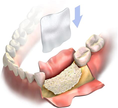 bone grafting san jose morgan hill bone graft  dental implants